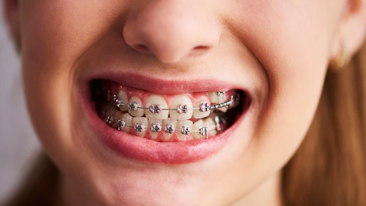 Effects Of Braces On Teeth Colour