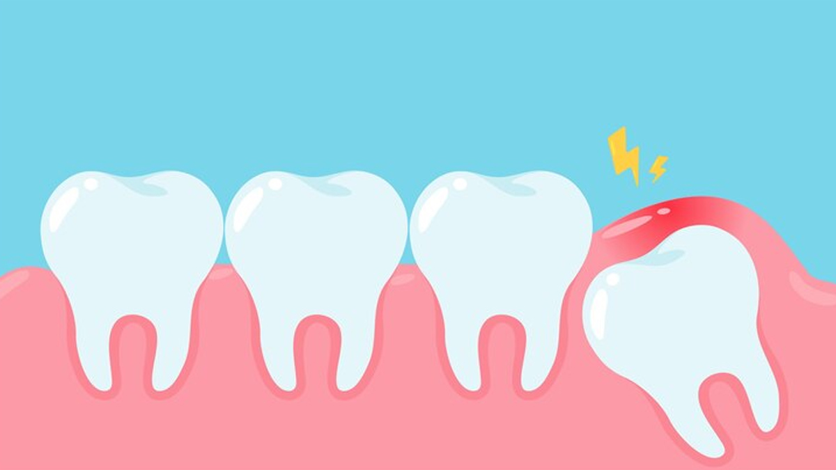 Impacted Wisdom Tooth- Treatment And Home Intervention