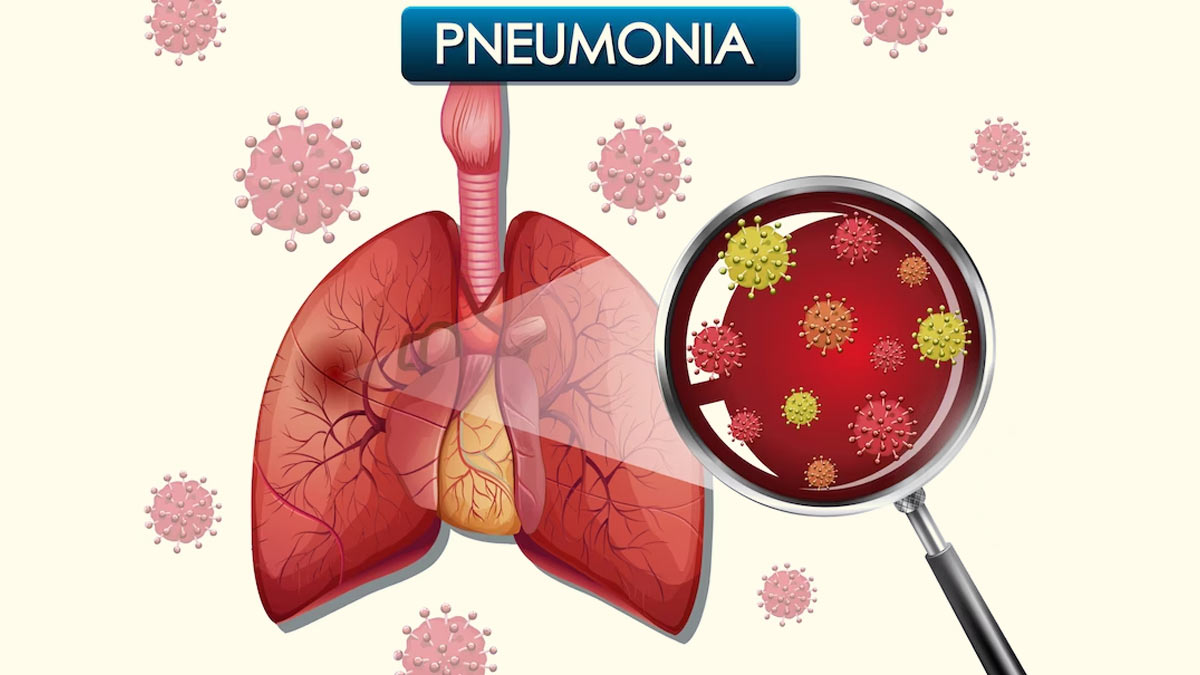 Causes Risk Symptoms And Prevention Of Pneumonia