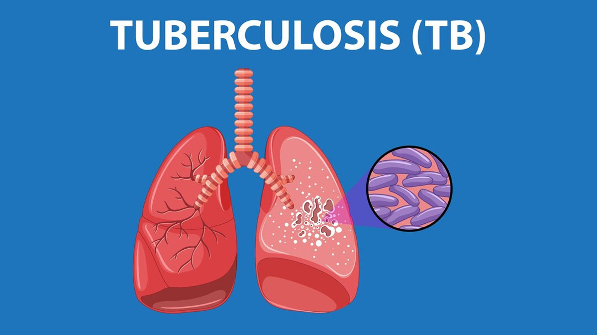 Types Of Tuberculosis | Onlymyhealth