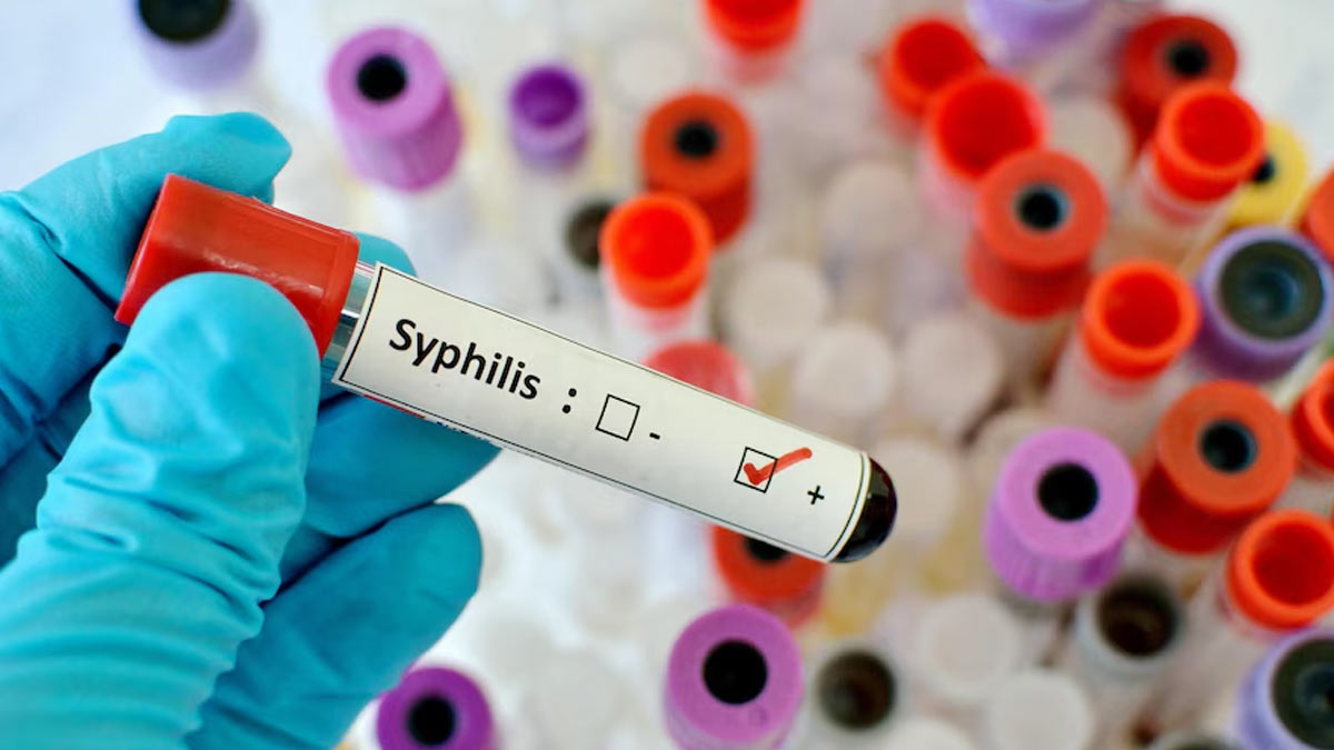 Can You Get Syphilis Without Sex? Expert Answers